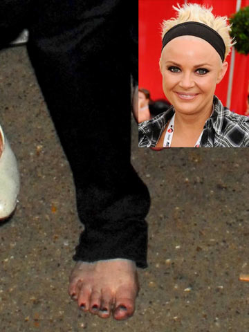 webbed toes celebrities